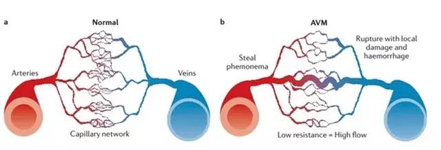 腦動靜脈畸形(AVM)的經顱多普勒表現 腦動靜脈畸形(AVM)的經顱多普勒表現
