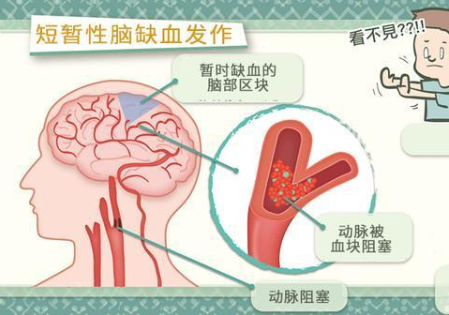 短暫性腦缺血是什么 經顱多普勒可確診