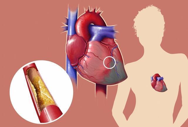 高血脂究是如何引發腦血管疾病的