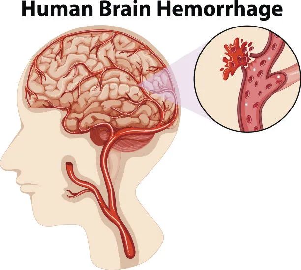 超聲經顱多普勒(TCD)檢測儀該如何使用